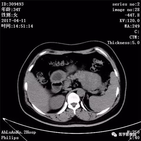 【病例】胰腺实性假乳头状瘤1例CT影像表现 【病例】胰腺实性假乳头状瘤1例CT影像表现