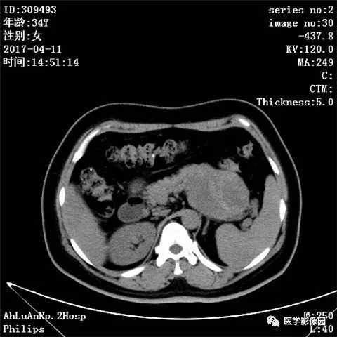 【病例】胰腺实性假乳头状瘤1例CT影像表现 【病例】胰腺实性假乳头状瘤1例CT影像表现
