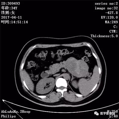 【病例】胰腺实性假乳头状瘤1例CT影像表现 【病例】胰腺实性假乳头状瘤1例CT影像表现