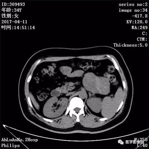 【病例】胰腺实性假乳头状瘤1例CT影像表现 【病例】胰腺实性假乳头状瘤1例CT影像表现