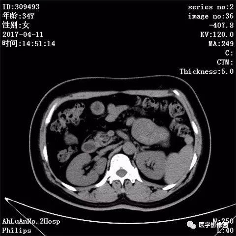 【病例】胰腺实性假乳头状瘤1例CT影像表现 【病例】胰腺实性假乳头状瘤1例CT影像表现