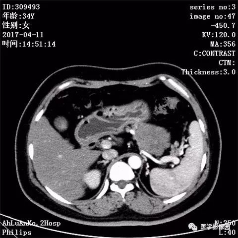 【病例】胰腺实性假乳头状瘤1例CT影像表现 【病例】胰腺实性假乳头状瘤1例CT影像表现