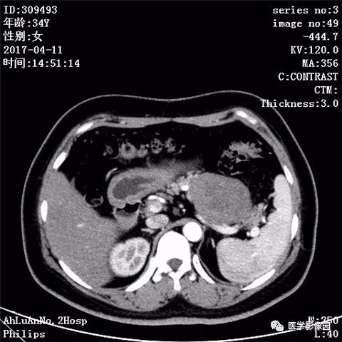 【病例】胰腺实性假乳头状瘤1例CT影像表现 【病例】胰腺实性假乳头状瘤1例CT影像表现