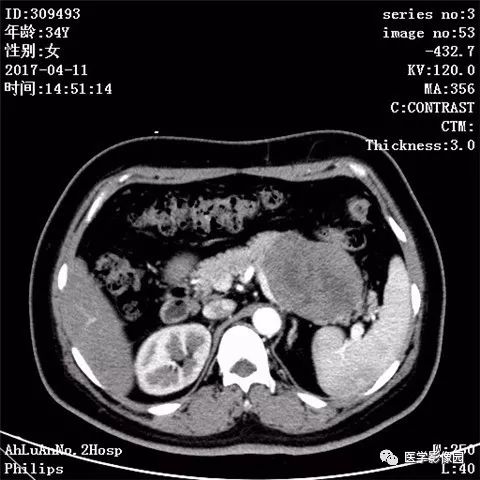 【病例】胰腺实性假乳头状瘤1例CT影像表现 【病例】胰腺实性假乳头状瘤1例CT影像表现
