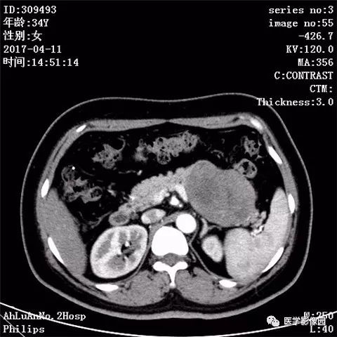 【病例】胰腺实性假乳头状瘤1例CT影像表现 【病例】胰腺实性假乳头状瘤1例CT影像表现