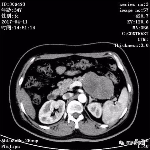 【病例】胰腺实性假乳头状瘤1例CT影像表现 【病例】胰腺实性假乳头状瘤1例CT影像表现