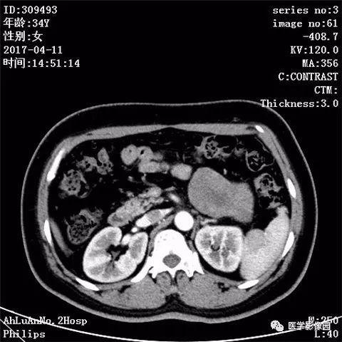 【病例】胰腺实性假乳头状瘤1例CT影像表现 【病例】胰腺实性假乳头状瘤1例CT影像表现