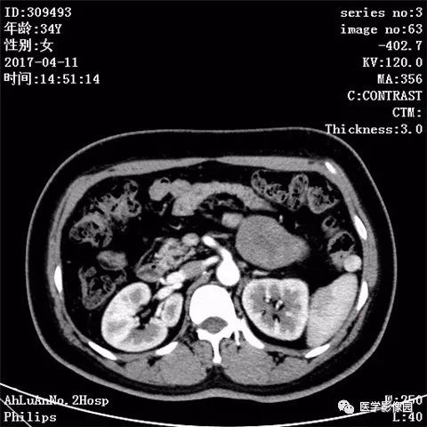 【病例】胰腺实性假乳头状瘤1例CT影像表现 【病例】胰腺实性假乳头状瘤1例CT影像表现