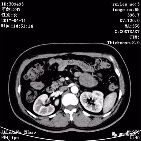 【病例】胰腺实性假乳头状瘤1例CT影像表现 【病例】胰腺实性假乳头状瘤1例CT影像表现