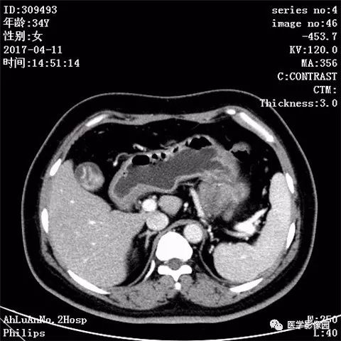 【病例】胰腺实性假乳头状瘤1例CT影像表现 【病例】胰腺实性假乳头状瘤1例CT影像表现