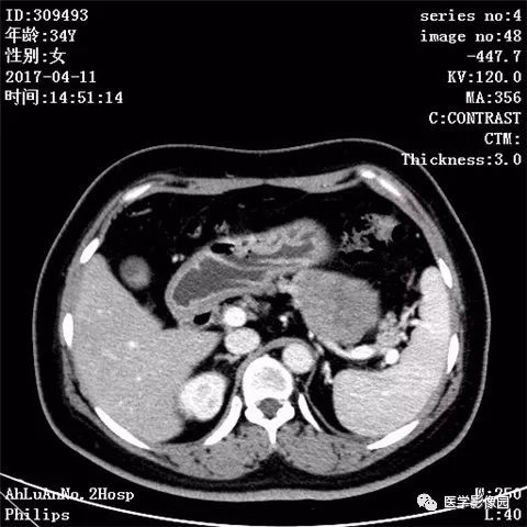【病例】胰腺实性假乳头状瘤1例CT影像表现 【病例】胰腺实性假乳头状瘤1例CT影像表现