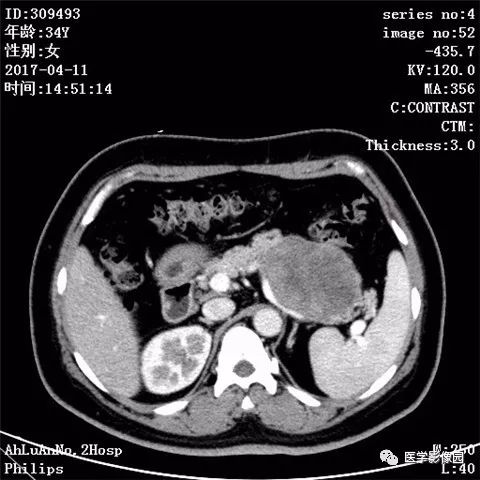 【病例】胰腺实性假乳头状瘤1例CT影像表现 【病例】胰腺实性假乳头状瘤1例CT影像表现