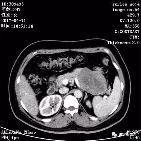 【病例】胰腺实性假乳头状瘤1例CT影像表现 【病例】胰腺实性假乳头状瘤1例CT影像表现