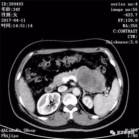【病例】胰腺实性假乳头状瘤1例CT影像表现 【病例】胰腺实性假乳头状瘤1例CT影像表现