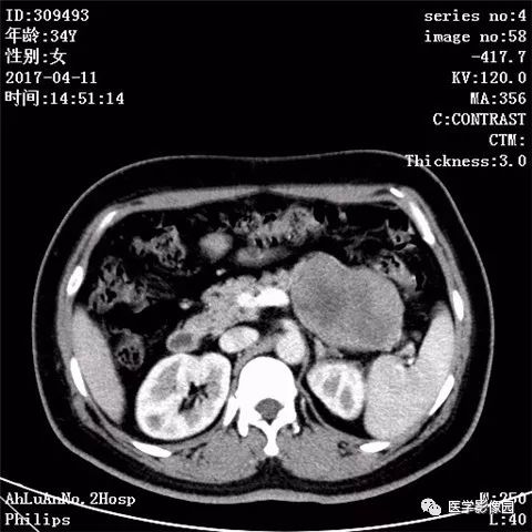 【病例】胰腺实性假乳头状瘤1例CT影像表现 【病例】胰腺实性假乳头状瘤1例CT影像表现