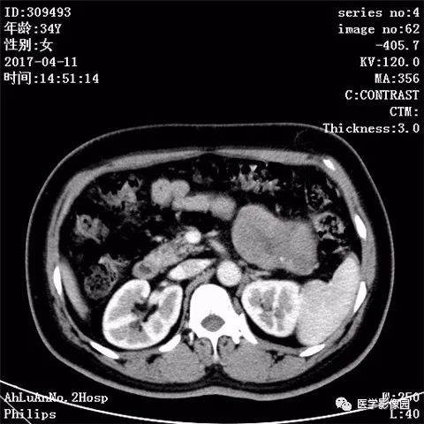 【病例】胰腺实性假乳头状瘤1例CT影像表现 【病例】胰腺实性假乳头状瘤1例CT影像表现