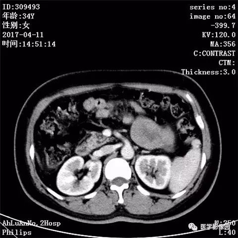 【病例】胰腺实性假乳头状瘤1例CT影像表现 【病例】胰腺实性假乳头状瘤1例CT影像表现