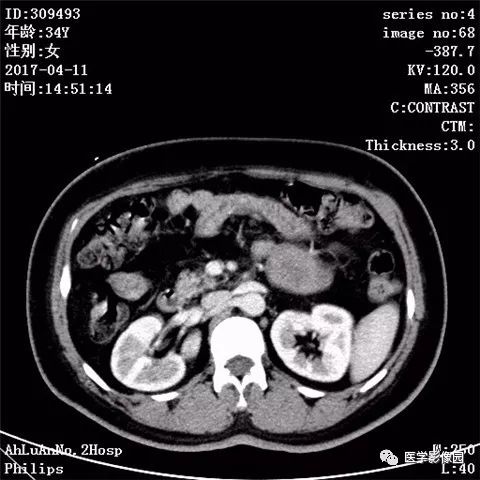 【病例】胰腺实性假乳头状瘤1例CT影像表现 【病例】胰腺实性假乳头状瘤1例CT影像表现
