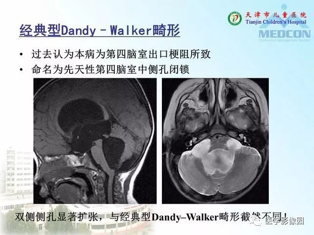 【PPT】先天性小脑畸形的影像学表现