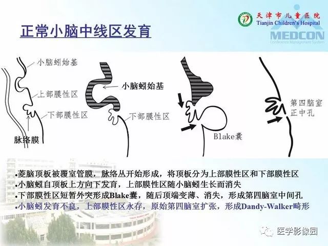 【PPT】先天性小脑畸形的影像学表现