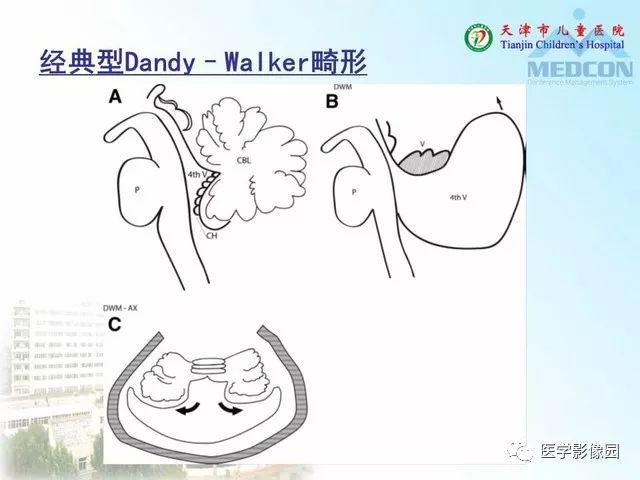 【PPT】先天性小脑畸形的影像学表现