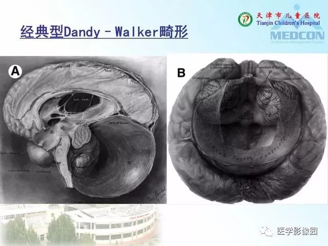 【PPT】先天性小脑畸形的影像学表现