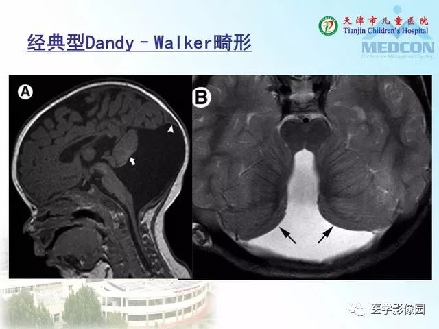 【PPT】先天性小脑畸形的影像学表现