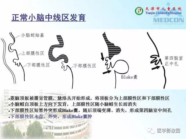 【PPT】先天性小脑畸形的影像学表现