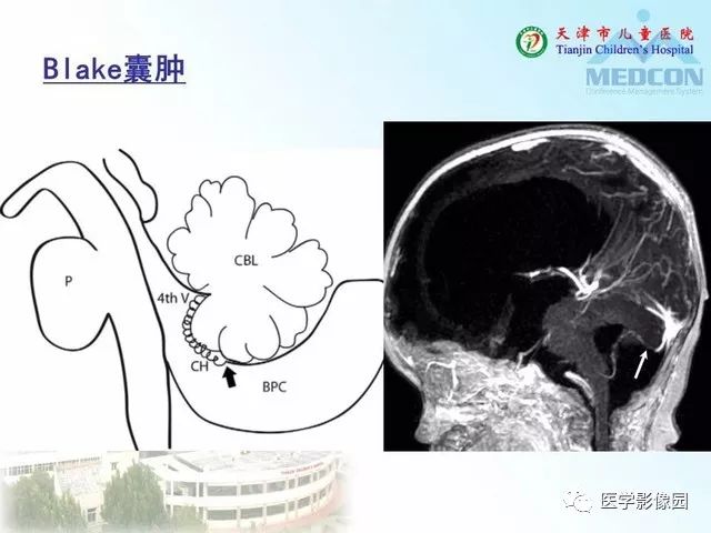 【PPT】先天性小脑畸形的影像学表现