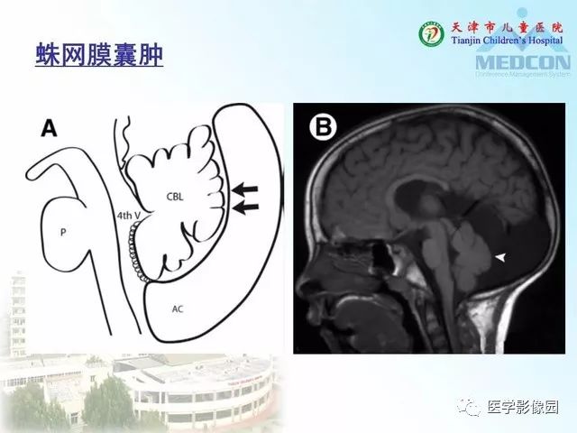 【PPT】先天性小脑畸形的影像学表现