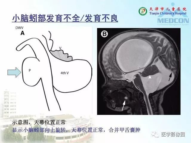 【PPT】先天性小脑畸形的影像学表现