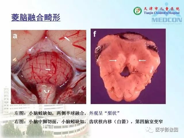 【PPT】先天性小脑畸形的影像学表现