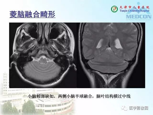 【PPT】先天性小脑畸形的影像学表现