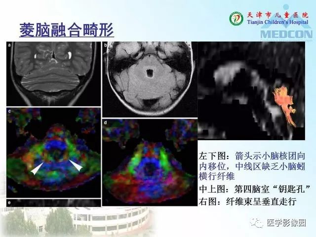 【PPT】先天性小脑畸形的影像学表现