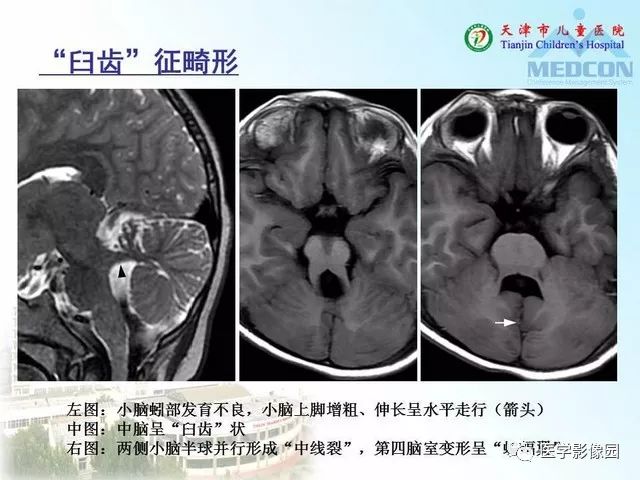 【PPT】先天性小脑畸形的影像学表现