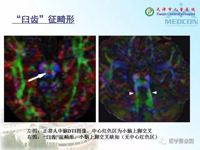 【PPT】先天性小脑畸形的影像学表现