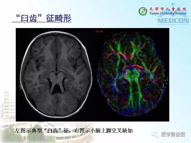 【PPT】先天性小脑畸形的影像学表现