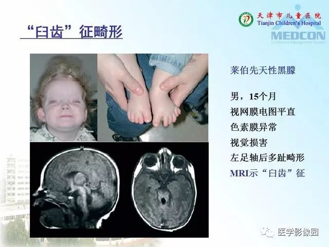【PPT】先天性小脑畸形的影像学表现