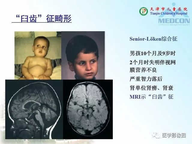 【PPT】先天性小脑畸形的影像学表现