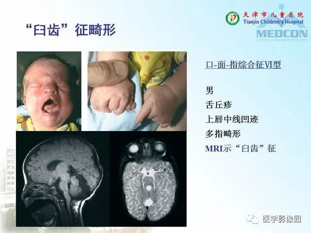 【PPT】先天性小脑畸形的影像学表现
