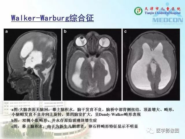 【PPT】先天性小脑畸形的影像学表现
