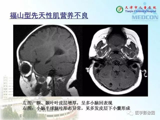 【PPT】先天性小脑畸形的影像学表现