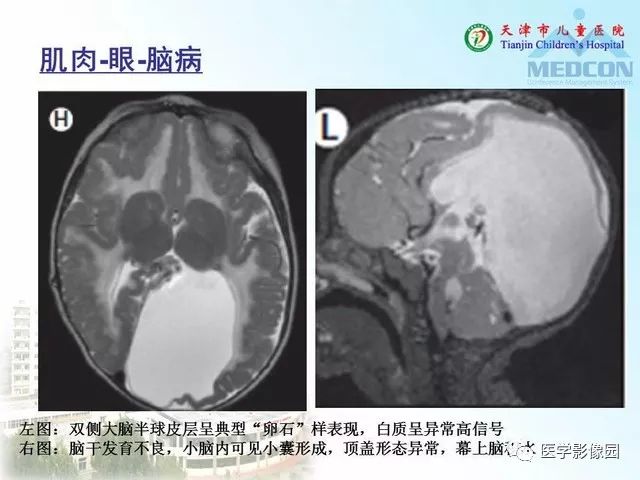 【PPT】先天性小脑畸形的影像学表现
