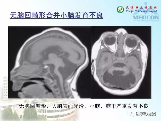 【PPT】先天性小脑畸形的影像学表现