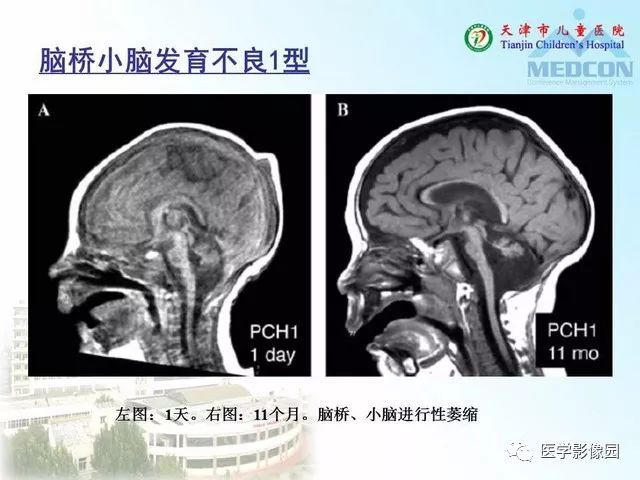 【PPT】先天性小脑畸形的影像学表现