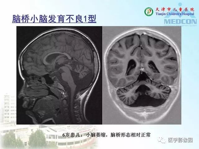 【PPT】先天性小脑畸形的影像学表现