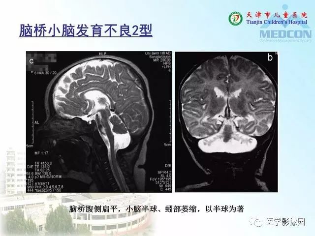 【PPT】先天性小脑畸形的影像学表现