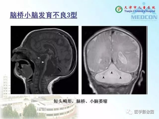 【PPT】先天性小脑畸形的影像学表现