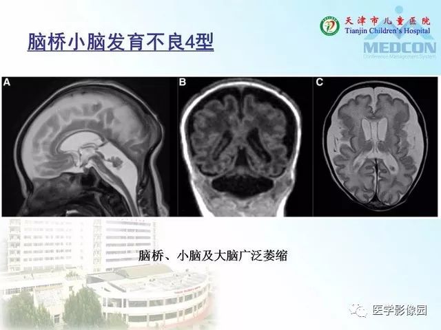 【PPT】先天性小脑畸形的影像学表现