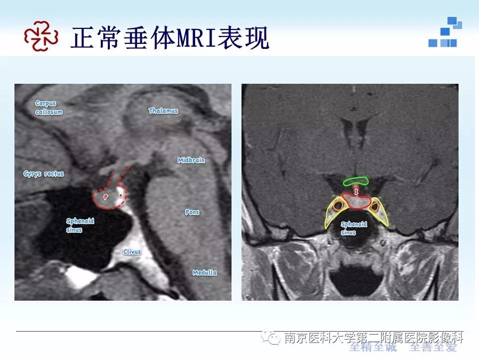 【PPT】专题读片—垂体柄阻断综合征